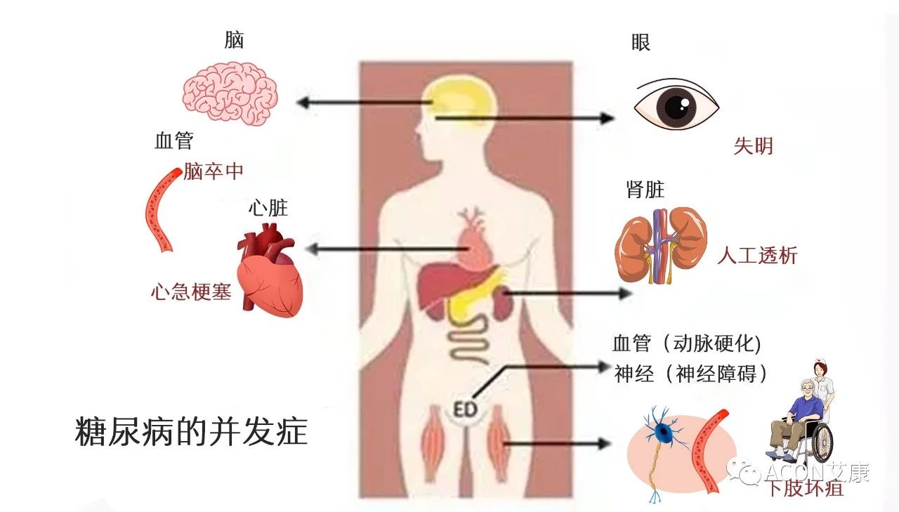 爆上熱搜，因爆發(fā)型糖尿病進入ICU，有哪些教訓值得我們汲取